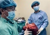 Phẫu thuật thành công cho bệnh nhân nặng 39kg mang khối u 6,5 kg